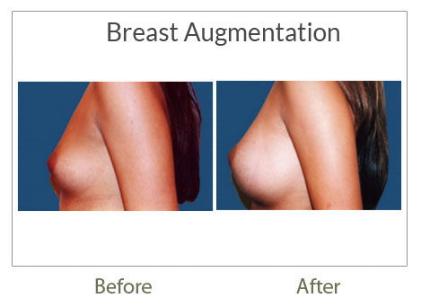 breast augmentation before-after