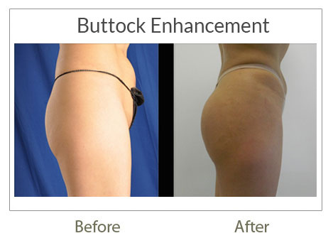 buttock before after surgery