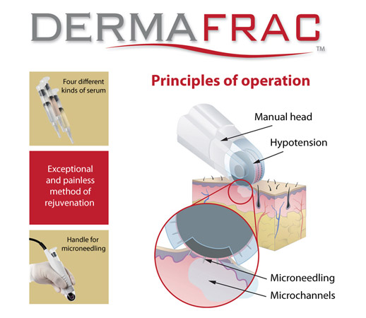 Dermafrac Treatment