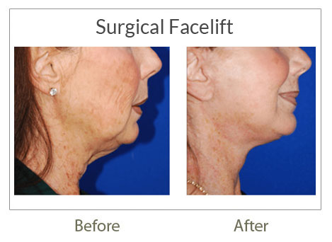 face lift surgery before after