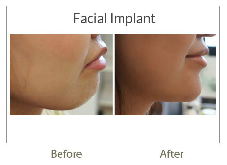 facial implant before-after