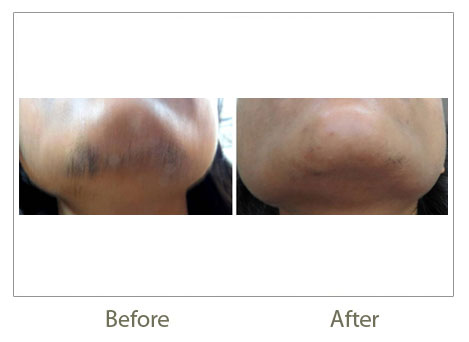 laser hair removal permanent