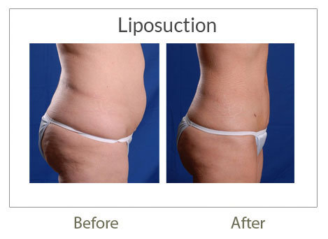 liposuction surgery before-after