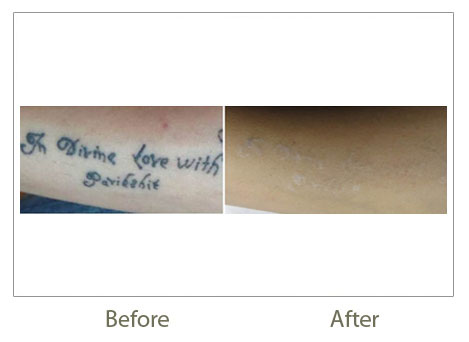 ... Tattoo Removal, Tattoo Removal, Laser Tattoo Removal in Delhi