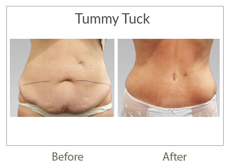 tummy-tuck surgery before-after