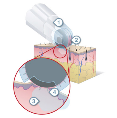 Dermafrac - Treatment for Instant glow and Rejuvenation of Skin