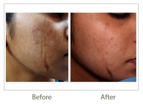 CO2 Laser Resurfacing & Patient Results 