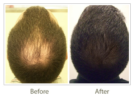 Hair Transplant Delhi