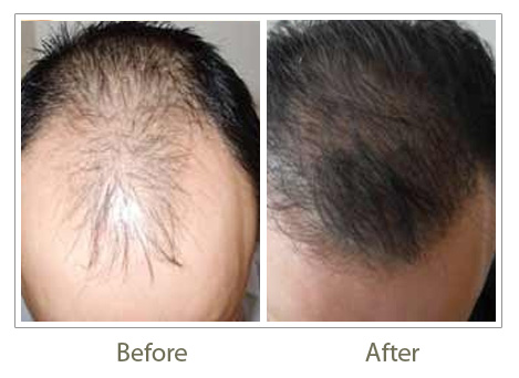 Hair Transplant in Delhi