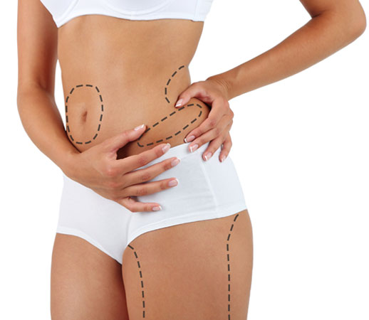 liposuction surgery