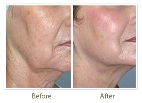 Mesotherapy Before And After Photos UXPHK