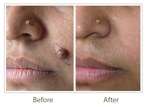 Recovery mole excision Laser mole