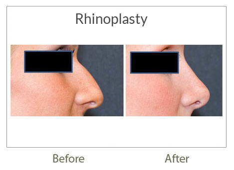 rhinoplasty before-after