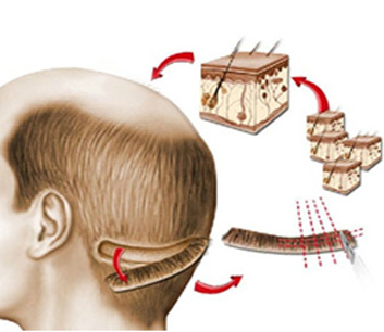 FUT Hair Transplant