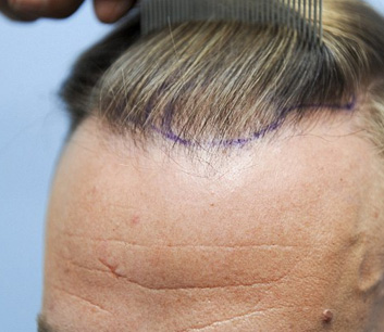 Hair Transplant clinic in Delhi