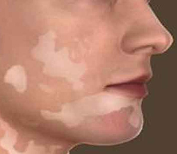 Vitiligo Treatment