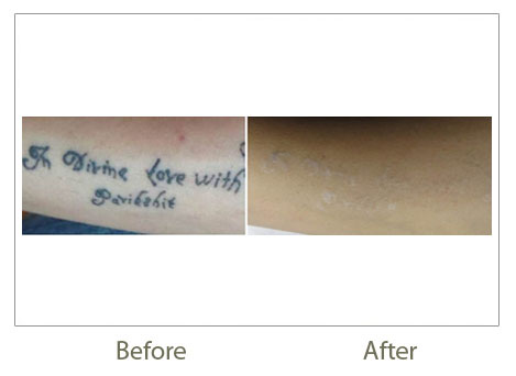 Tattoo Removal from Hands
